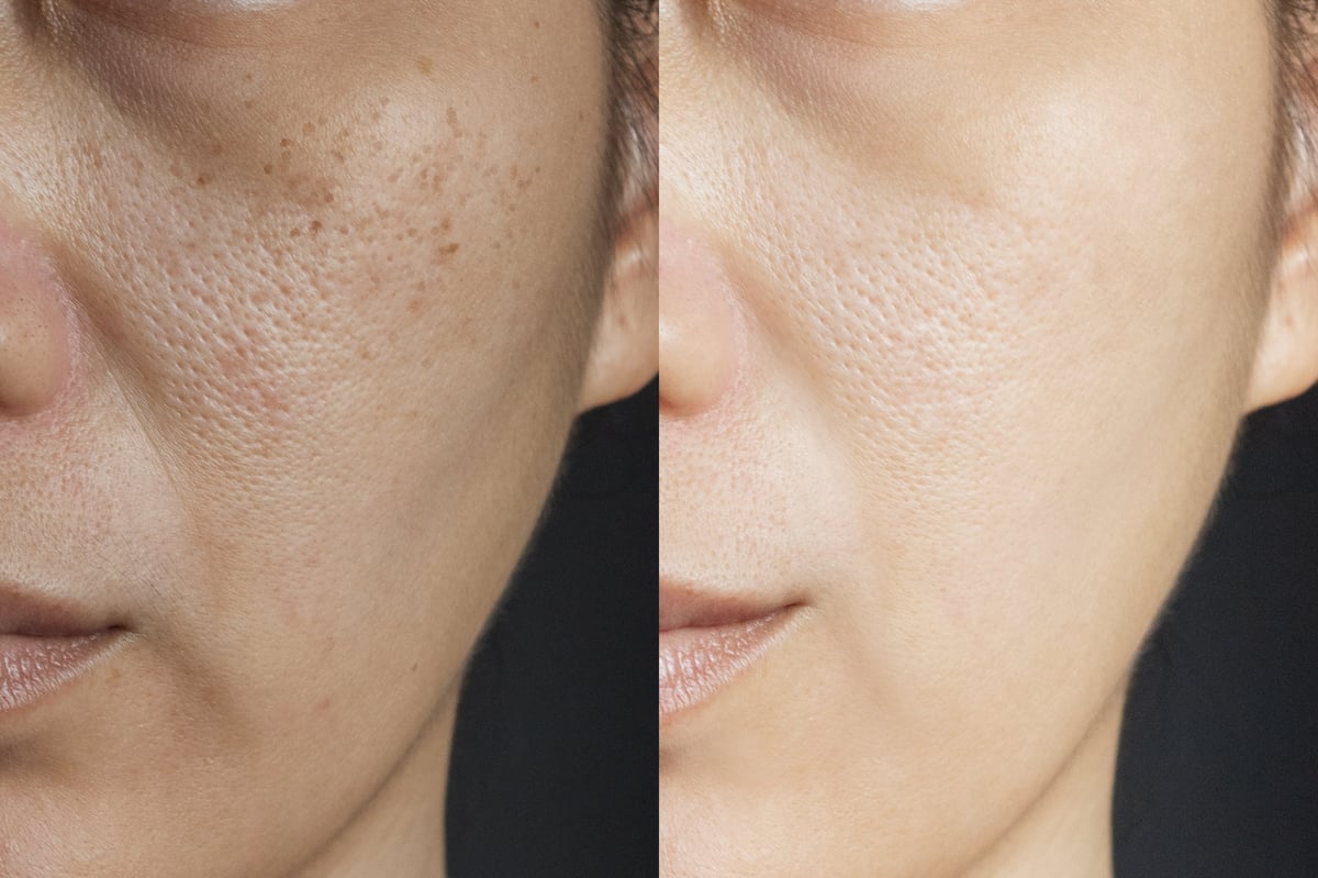 Antes y después del tratamiento Carbon Peel con Láser Q-Switch