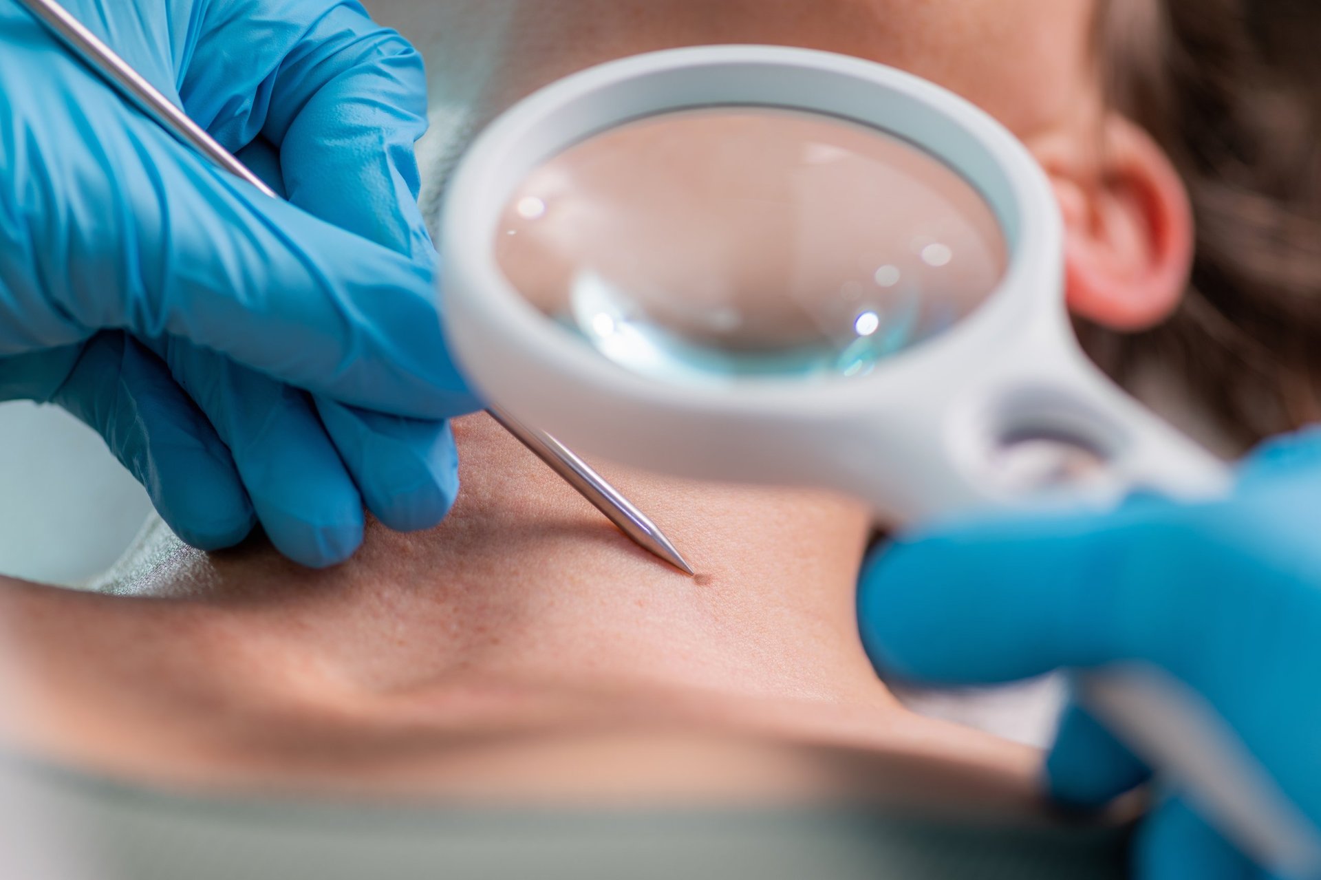 Dermatology treatment of warts, removal utilizing the power of radio waves. Treating warts and ensuring smooth and blemish-free skin.