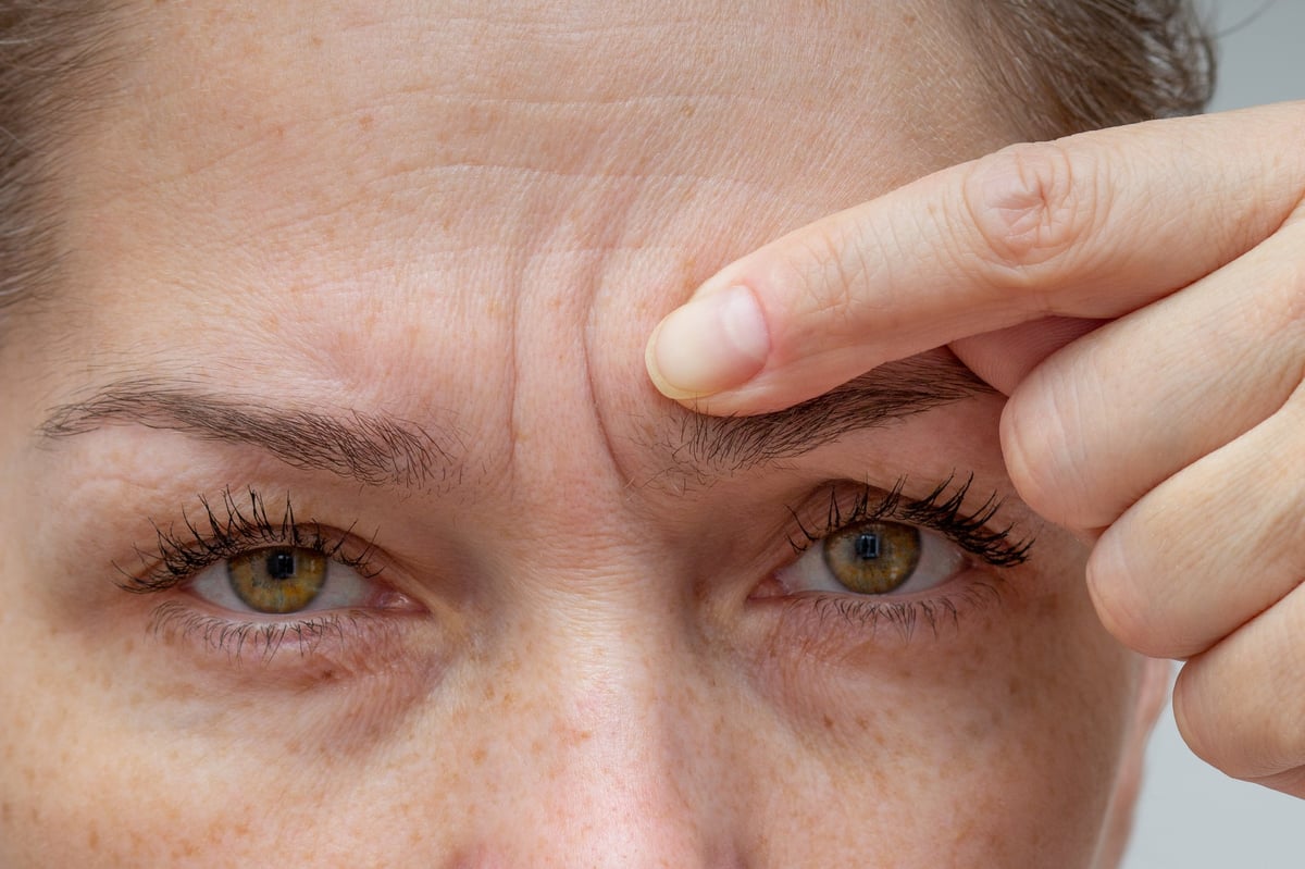 Mujer señalando arrugas en el entrecejo - tratamiento con toxina botulínica Allergan