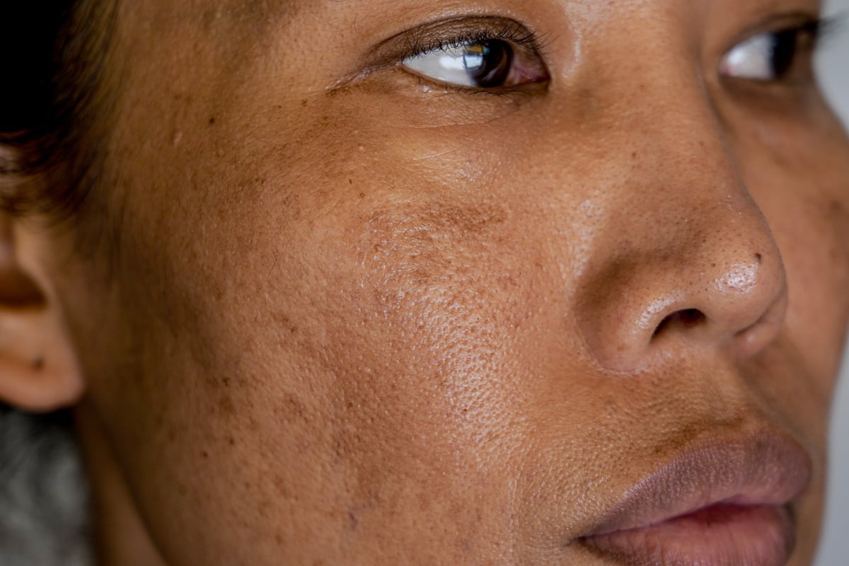 Mujer asiática con melasma y manchas de hiperpigmentación en los pómulos antes de tratamiento despigmentante