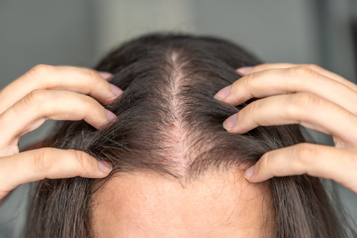 Close-up view of scalp after mesotherapy injections for alopecia treatment