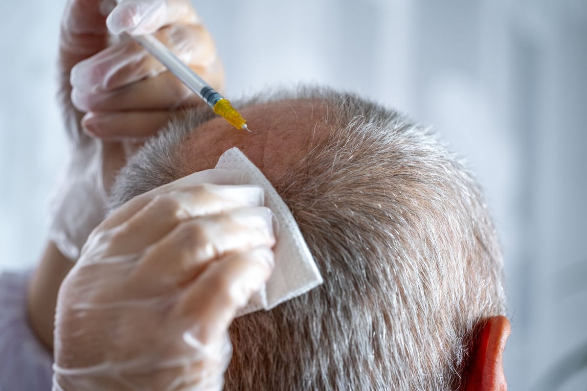 Trichologist performs scalp injections on man's balding area, promoting hair growth with exosome therapy
