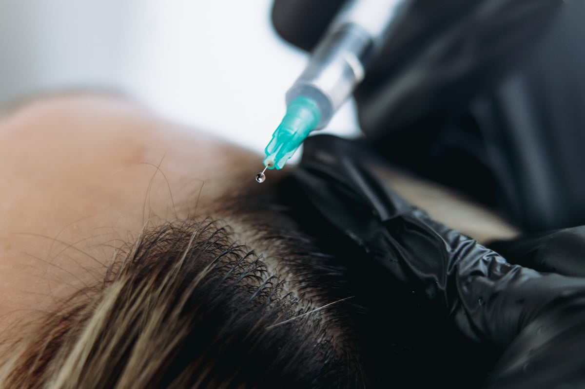 Close up on woman head getting mesotherapy injections for stronger and healthier hair