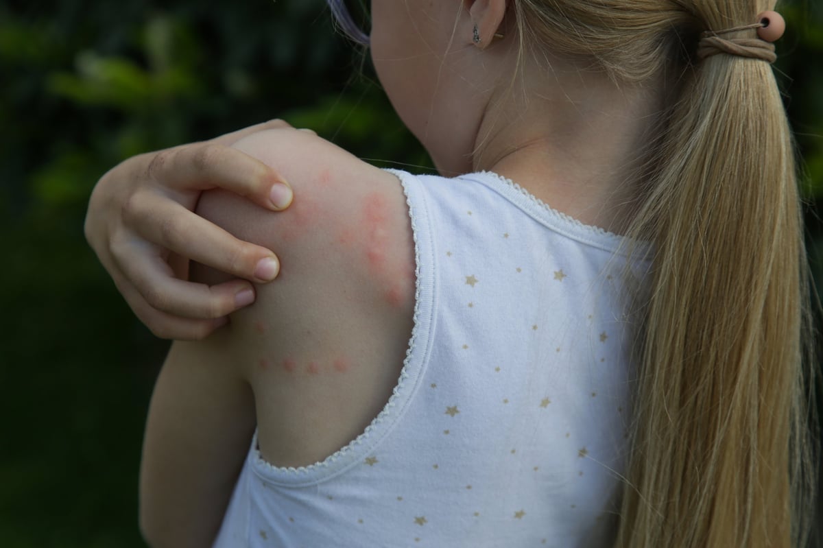 Red, swollen and itchy spots on skin caused by insect bites or allergy. Skin reaction to insect bites.