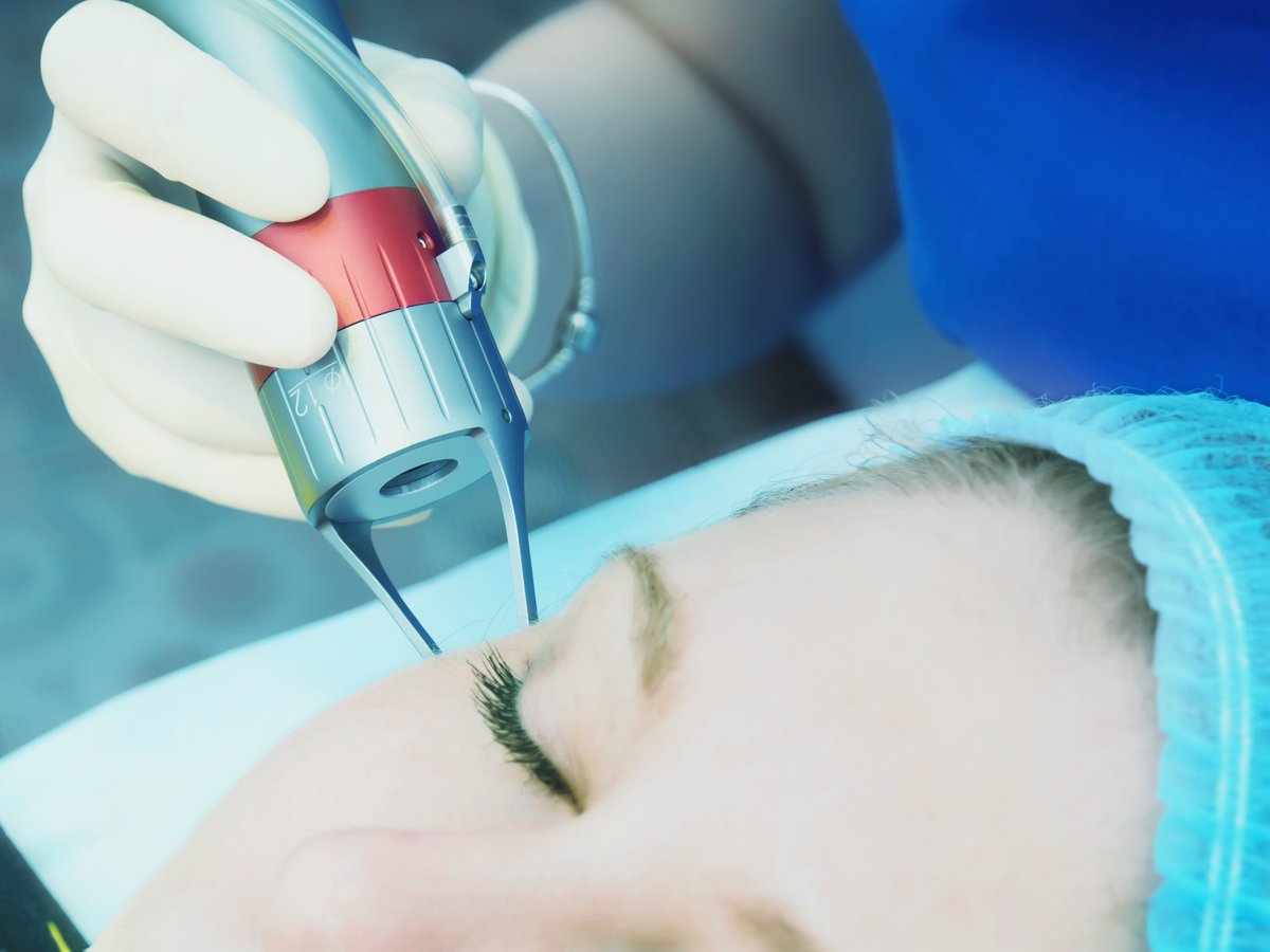 Láser CO2 fraccionado en párpados - rejuvenecimiento del contorno de ojos