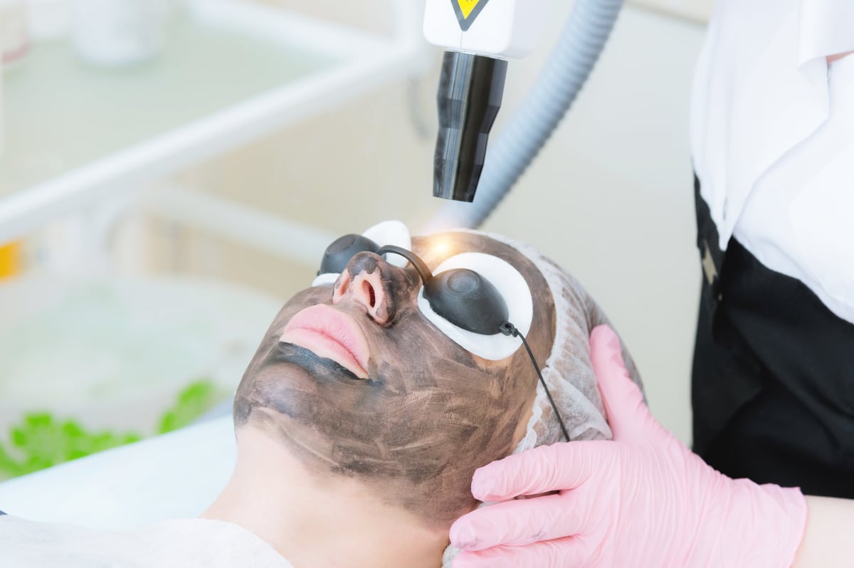 Close-up carbon face peeling procedure. Laser pulses clean skin of the face. Hardware cosmetology treatment. Process of photothermolysis, warming the skin, laser carbon peeling. Facial skin rejuvenation